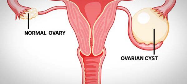 Ovarian cysts
