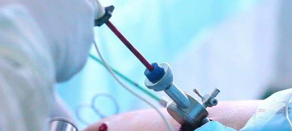 Single Incision Laparoscopic Surgery