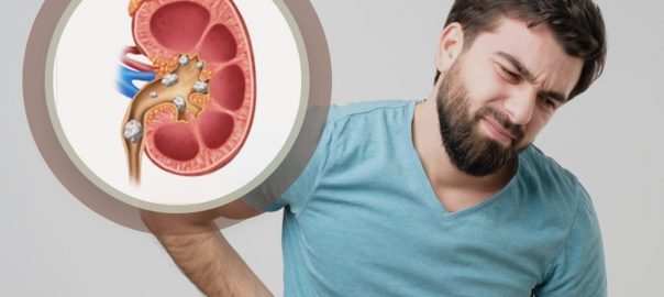 kidney stone laser treatment in Rohini