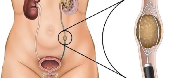 Ureteral stones